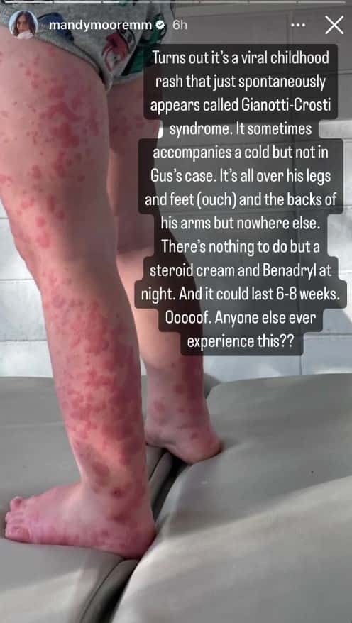 Mandy Moore's two-year-old son, Gus has been diagnosed with Gianotti-Crosti syndrome (@mandymooremm/Instagram Story)