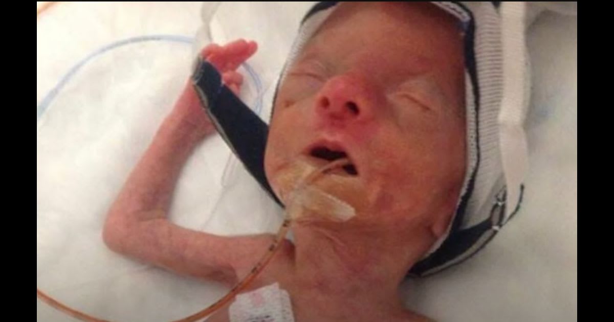 Kynadee was born at 28 weeks. She weighed only 1.4 pounds and had respiratory and pulmonary complications. (WFAA/YouTube)