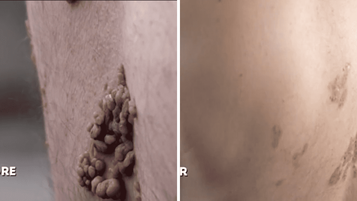 Before and After Stuart's surgery in 'Dr Pimple Popper' Season 8 (TLC)