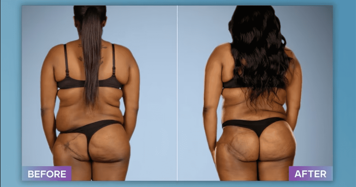 Desitny got her BBL corrected by 'Botched' Dr Terry Dubrow (E!Entertainment)