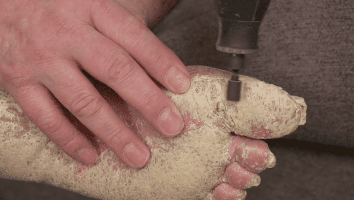 Dr Sandra Lee treating Felipe's foot on 'Dr Pimple Popper' Season 9 episode 14 (TLC)