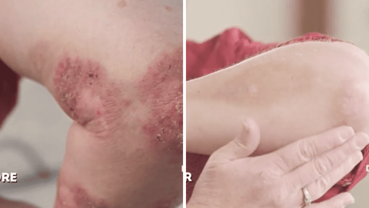 Before and After Donna's medication therapy in 'Dr Pimple Popper' Season 8 (TLC)