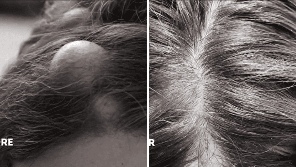 Before and After Aimee's surgery in 'Dr Pimple Popper' Season 8 (TLC)