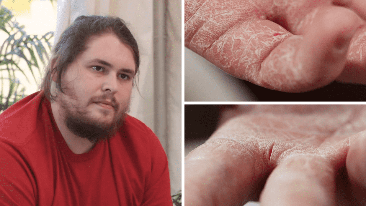 'Frustrated' Tyler seeks help from 'Dr Pimple Popper' (Twitter/tlc)