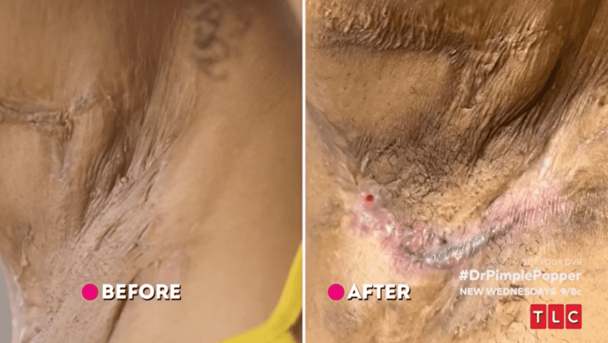 Before and After Chanel's treatment in 'Dr Pimple Popper' Season 8 (TLC)