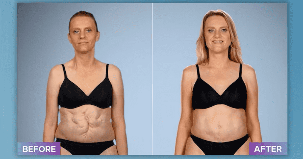 Sandr after her abdominal recontruction surgery from 'Botched' Dr Terry Dubrow (E!Entertainment)