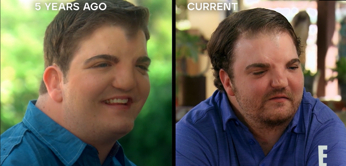 Nates Gomes after his surgery on 'Botched by Nature' (E!Entertainment)