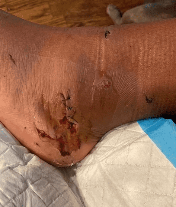 Megan Thee Stallion, 28, shared picture of her injured leg due to shooting (Instagram)