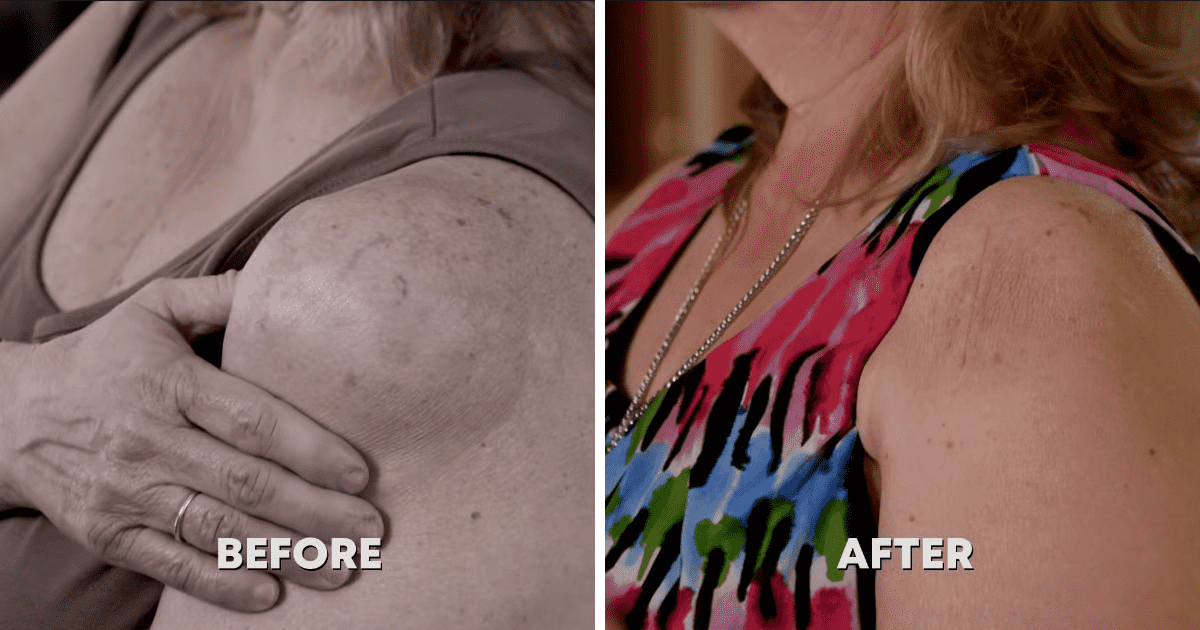 Debbie Gibson's lipoma and scar was completely gone after 6-weeks of surgery from Dr Sandra Lee (TLC)