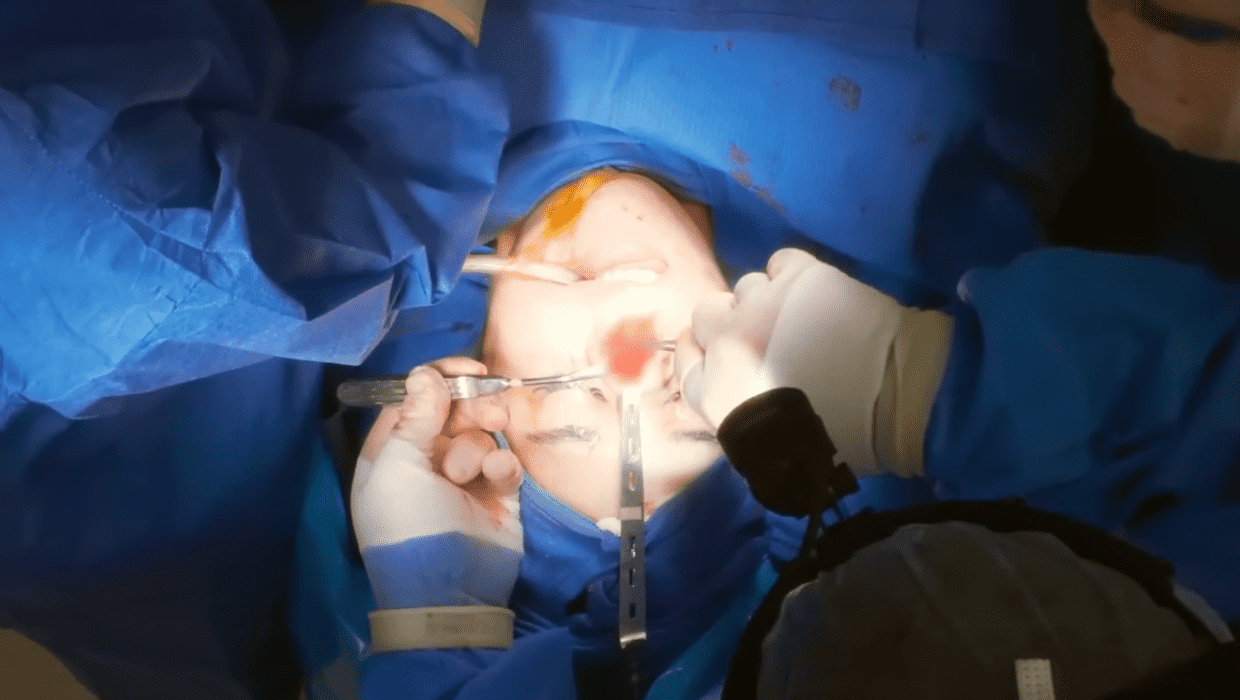 Mellissa's surgery on 'Botched' Season 8 episode 1  (YouTube/E!Entertainment)