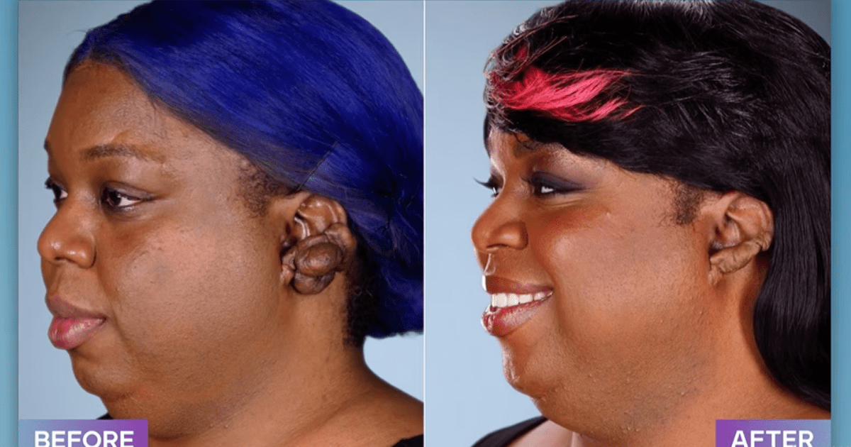 Tyliyah before and after 'Botched' Season 8 surgery (E!Entertainment)