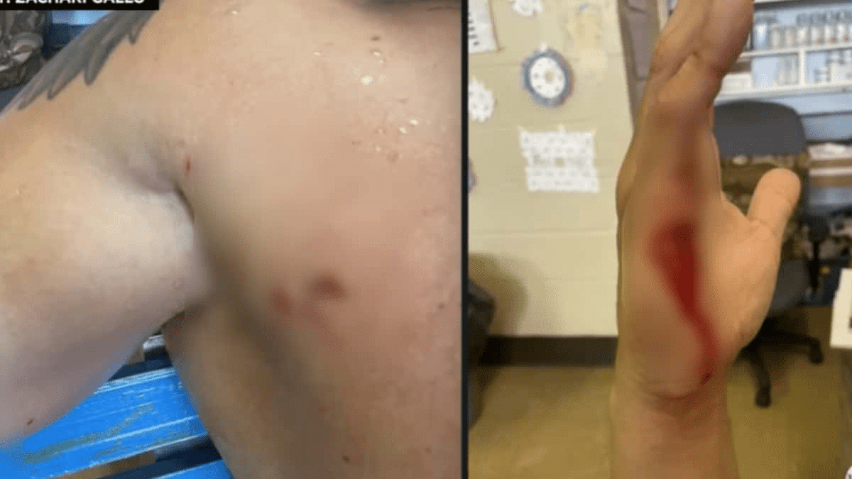 Smith Point Beach lifeguard Zack Gallo was bitten in the chest and right hand during his terrifying encounter (CBS New York/YouTube)