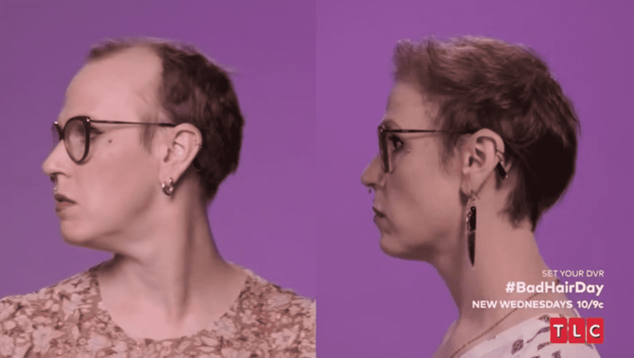 Before and After Jamie's hair restoration treatment in 'Bad Hair Day' Season 1 episode 1 (TLC)
