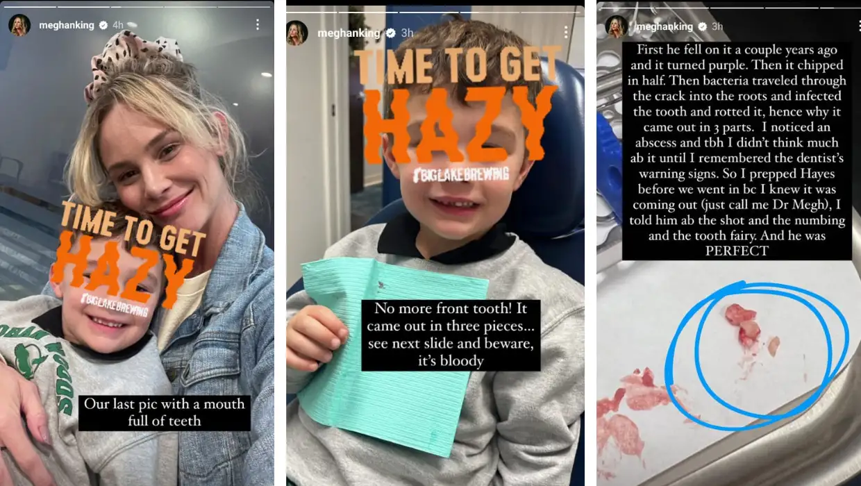 'RHOC' star Meghan King's son Hayes got his teeth pulled (Instagram/@meghanking)