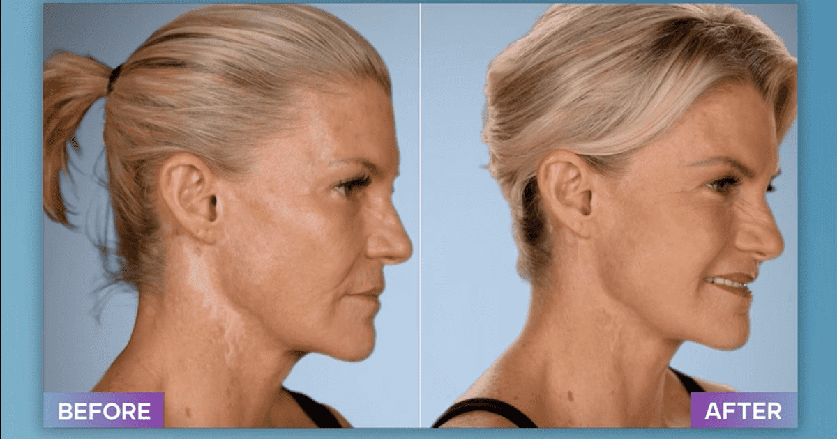 Before and After Jo Anna Bernal's surgery on 'Botched' Season 8 (E!Entertainment)