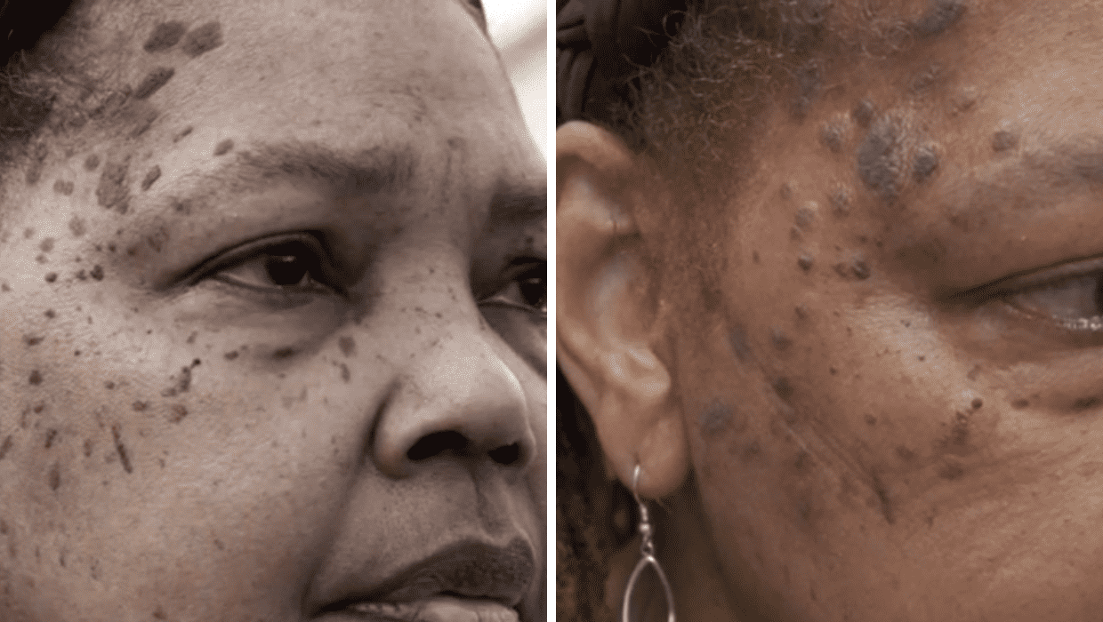 Before and After Edith's treatment in 'Dr Pimple Popper' Season 8 (TLC)