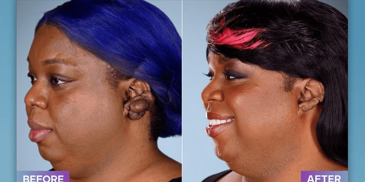 Tyliyah before and after her surgery on 'Botched' Season 8 (E!Entertainment)