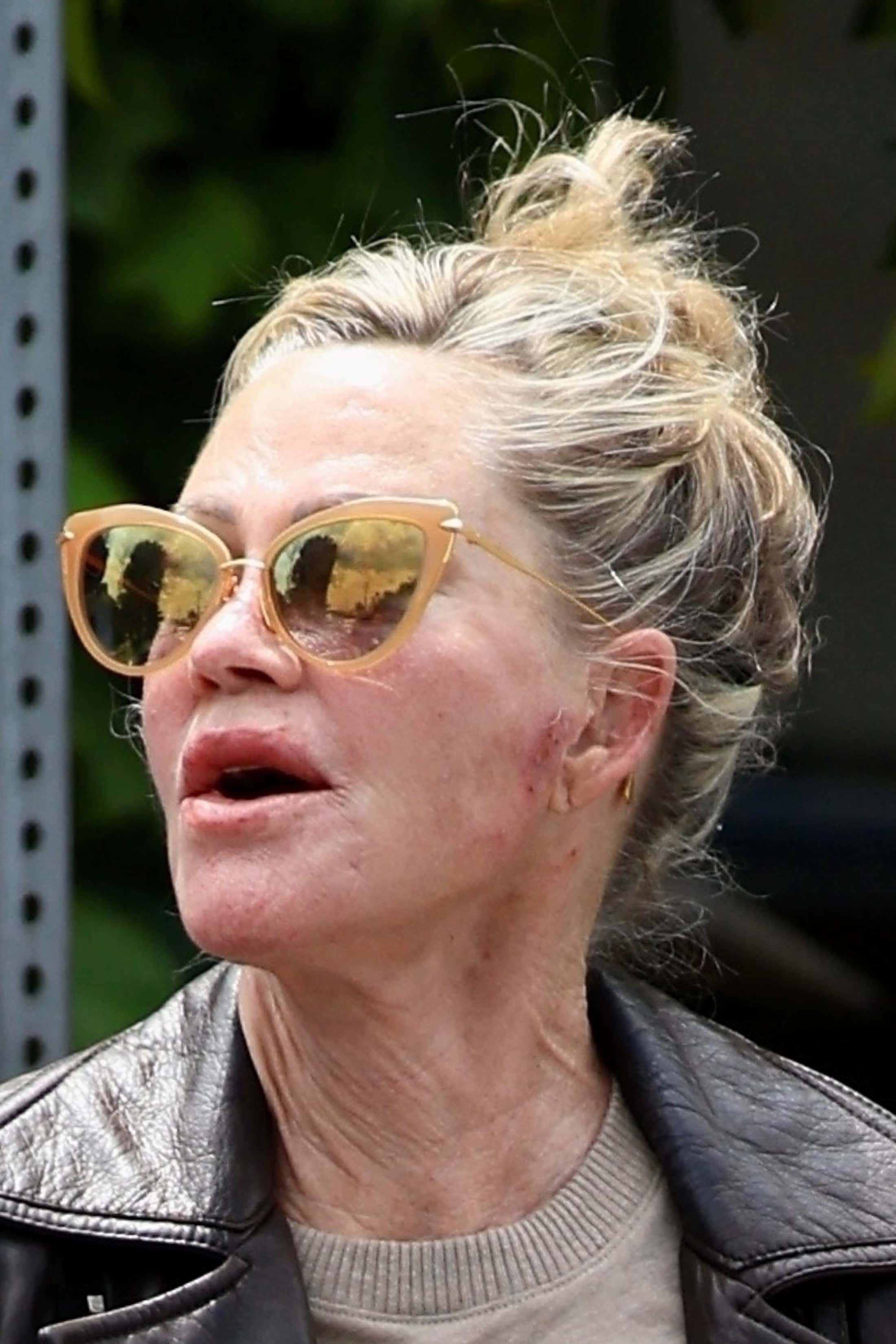 Melanie Griffith is battling skin cancer (Backgird)
