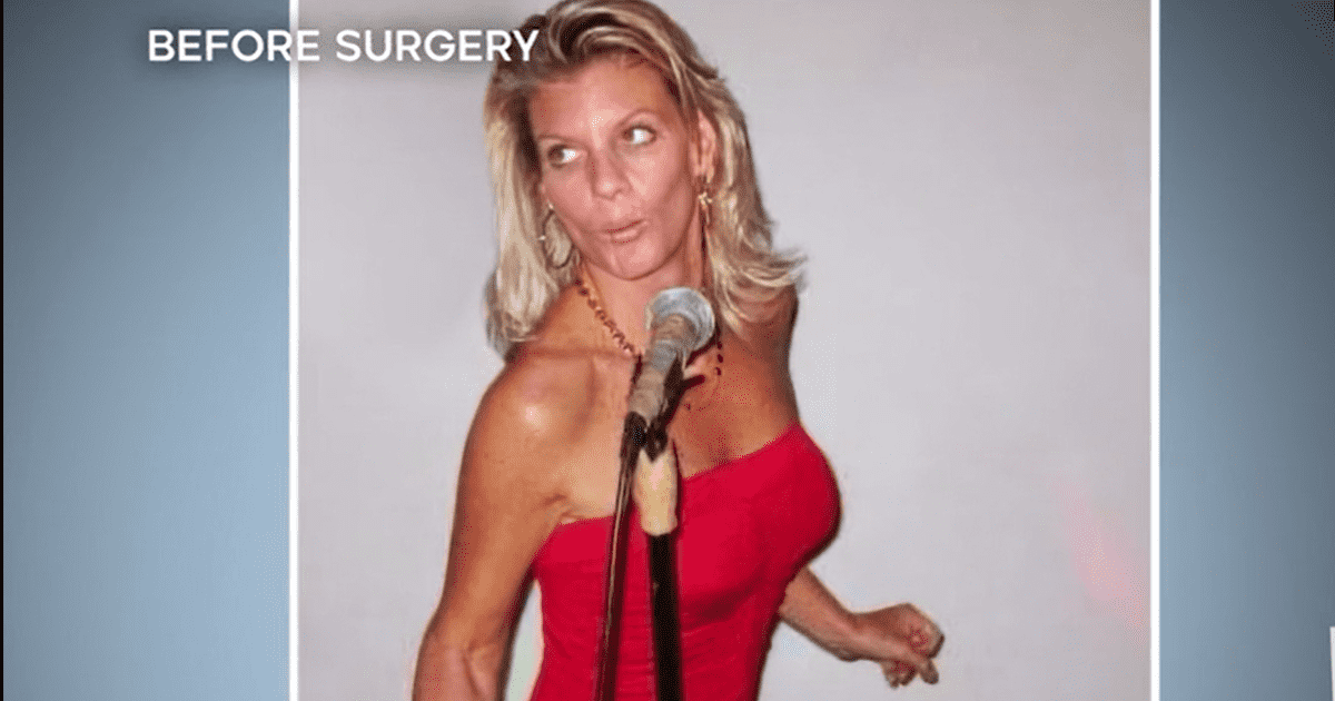 'Botched' patient Jo Anna Bernal before her first deep-plane facelift (E!Entertainment)