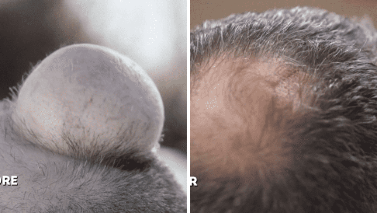 Before and After Michael's surgery in 'Dr Pimple Popper' Season 8 (TLC)