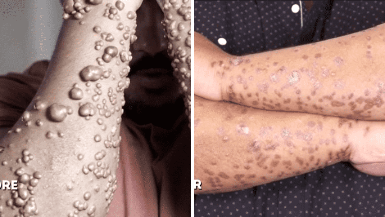 Before and After Robert's surgery in 'Dr Pimple Popper' Season 8 (TLC)