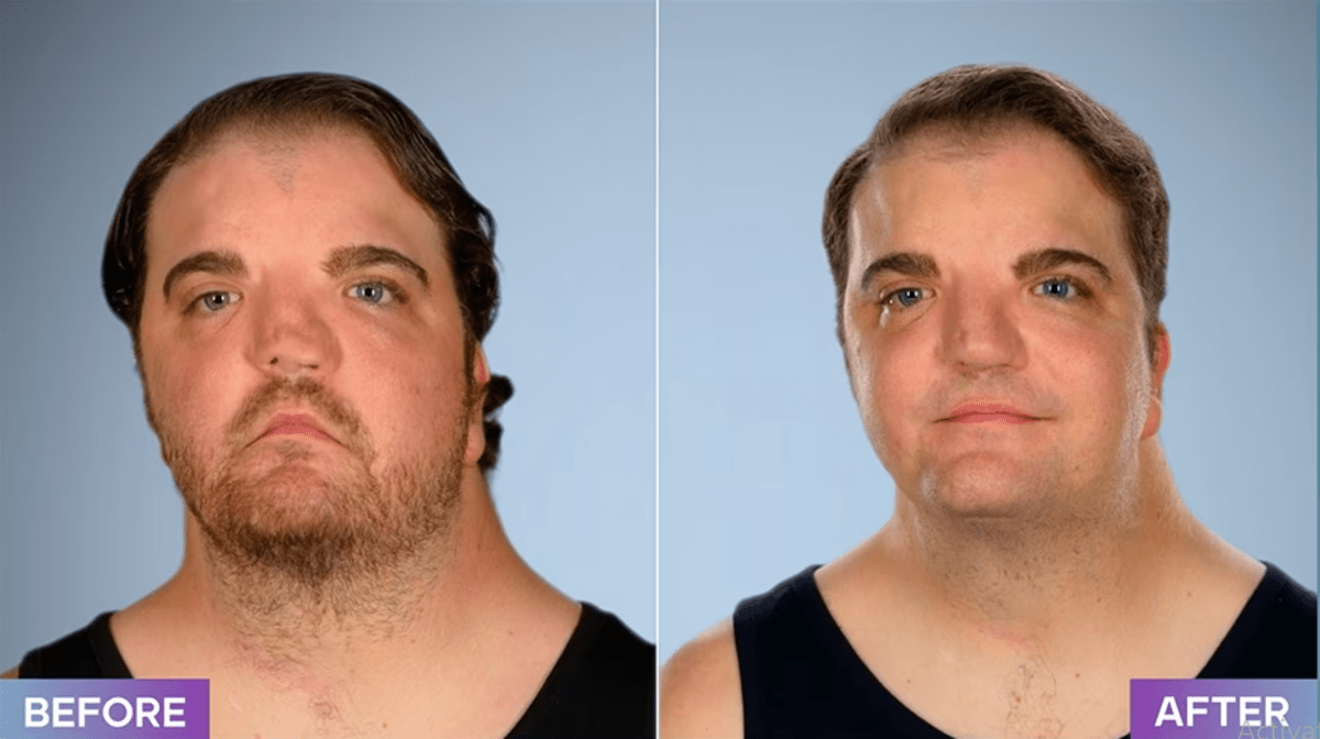 Nates Gomes before and after his surgery on 'Botched' Season 8 (E!Entertainment)