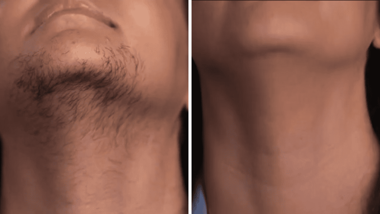 Before and After Charli's laser hair removal in 'Bad Hair Day' (TLC)