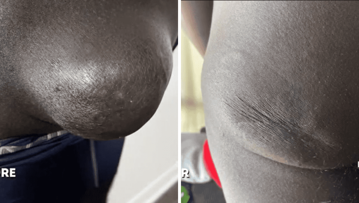 Before and After Jamaal's surgery in 'Dr Pimple Popper' Season 8 (TLC)