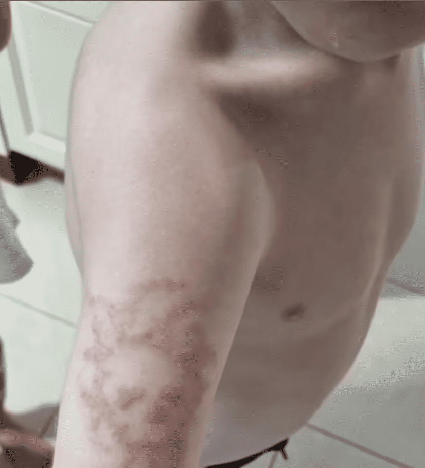 4-year-old Riley suffered intense rashes all over the body after an allergic reaction to a black henna tattoo. (Jess Kingscote handout to Daily Mail Australia)