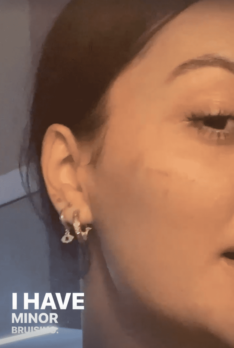 Victoria Zito posting about the minor bruising caused by her plastic surgery (@victorialzito/Instagram)