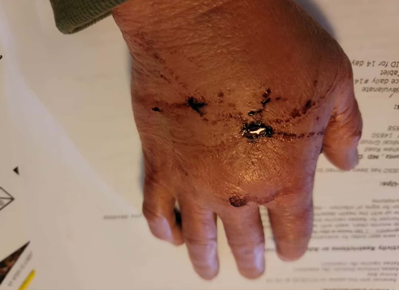 An image of the woman's hand after the attack