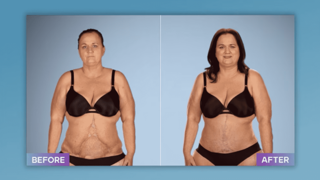 Mikeal after surgery on 'Botched' Season 8 episode 1 (Facebook/Botched)