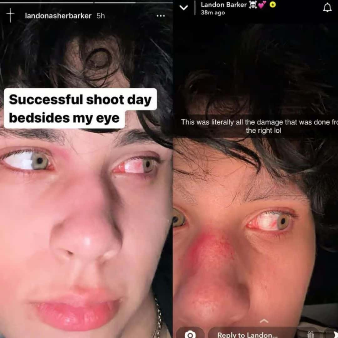 (@landonbarker/Snapchat)In a weekend fight, Landon Barker allegedly showed off a bloody eye.
