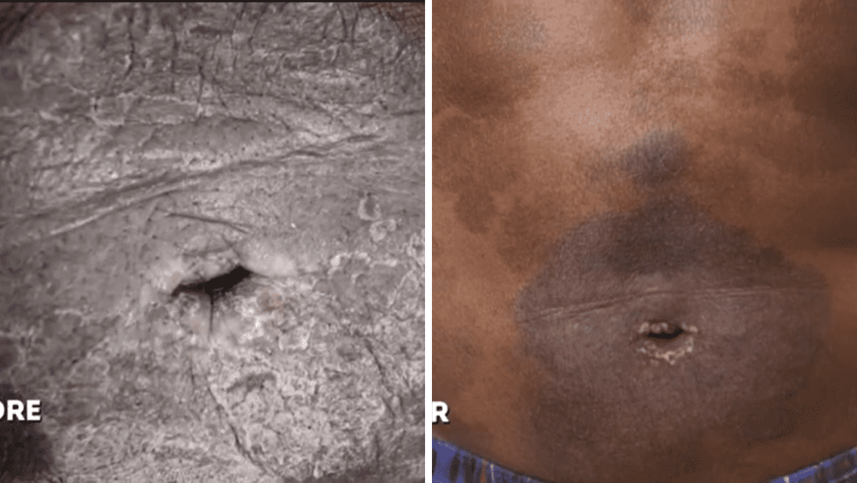 Before and After Johnnie's treatment in 'Dr Pimple Popper' Season 8 (TLC)