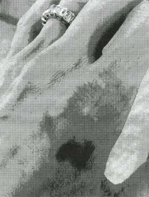 The bruises of Angelina Jolie on her hand caused allegedly due to Brad Pitt's attack (FBI)