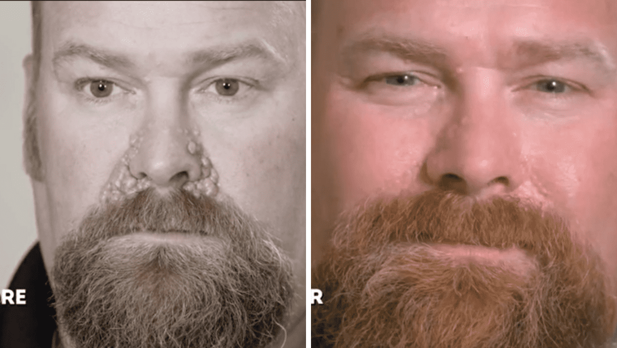 Before and After Dwayne's surgery in 'Dr Pimple Popper' Season 8 (TLC)