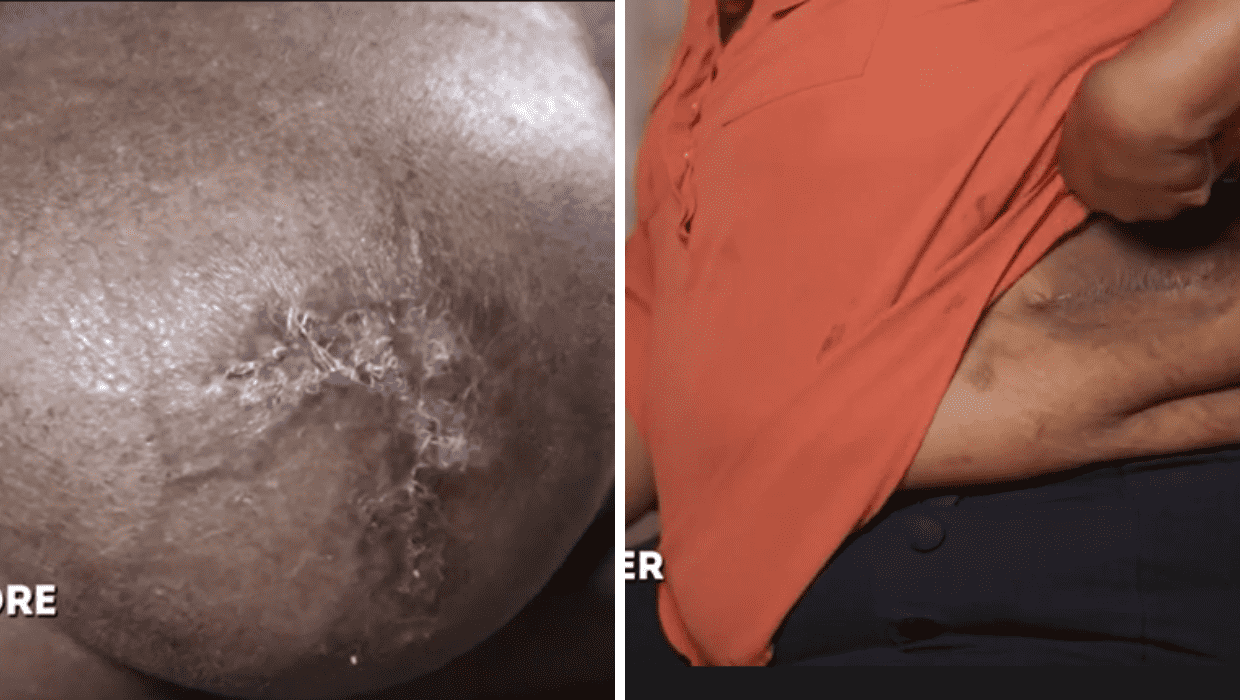 Before and After Elaine's operation in 'Dr Pimple Popper' Season 8 (TLC)