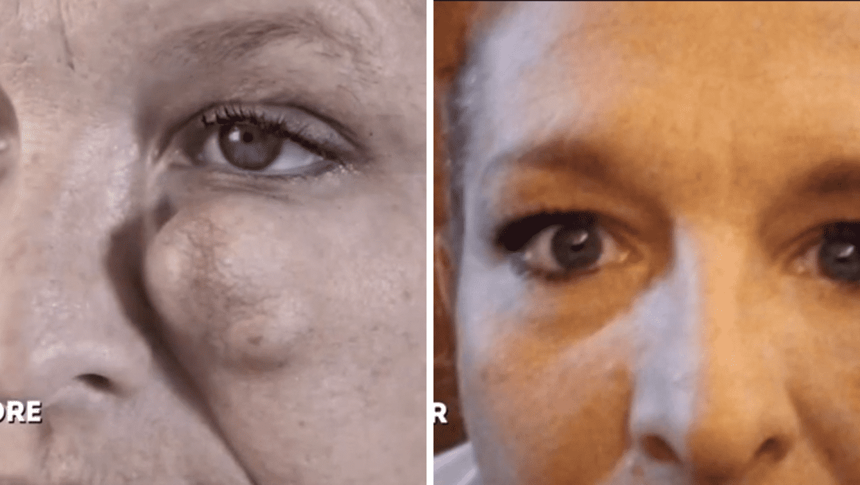 Before and After Jessica's surgery in 'Dr Pimple Popper' Season 8 (TLC)