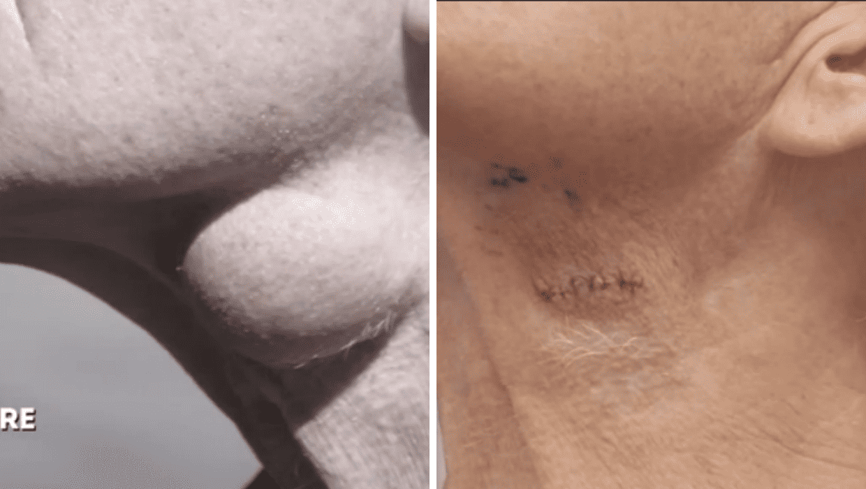 Before and After Jerry's surgery in 'Dr Pimple Popper' Season 8 (TLC)