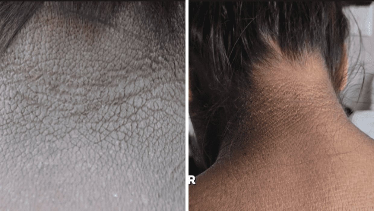 Before and After Breanna's treatment in 'Dr. Pimple Popper' Season 8